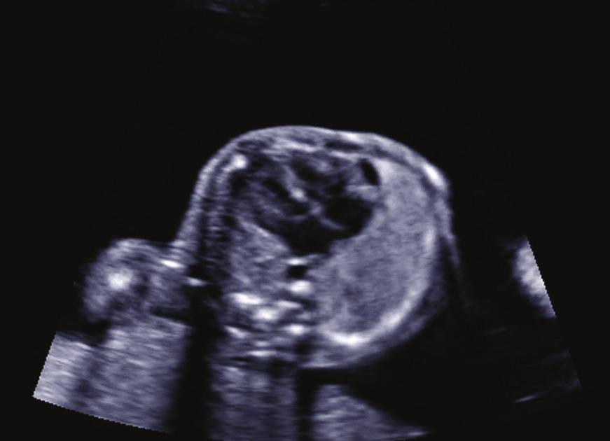 2 Case Reports in Pediatrics (a) (b) (c) (d) Figure 1: (a) Ultrasound examination at 21 weeks GA shows a four chamber view with a very mild right ventricle hypertrophy and mildly pericardial effusion.