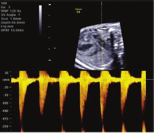 (c) Ultrasound examination at 21 weeks GA shows the pulmonary valve with a mild post stenotic dilatation. Valve cusps and pulmonary wall were echogenic and thickened.