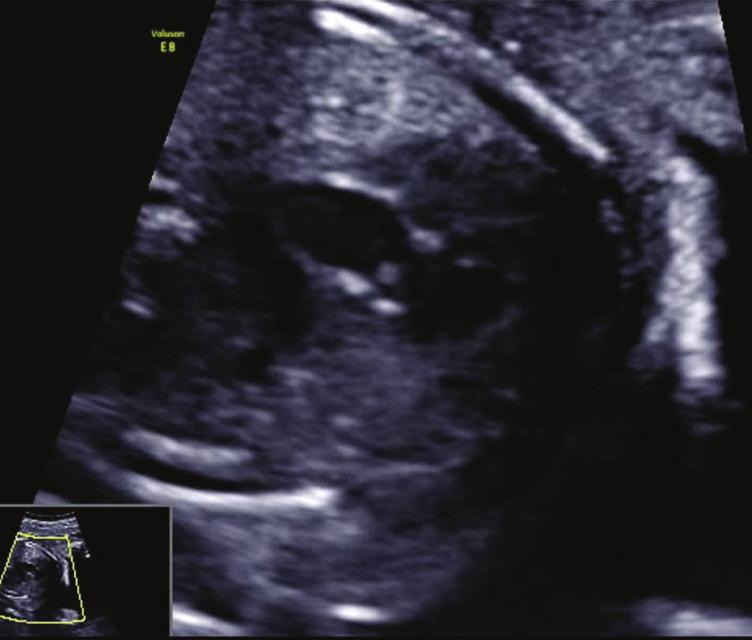 At 19 + 1 weeks, the pulmonary valve in the larger twin had a normal diameter for gestational age, but they showed echogenic valve cusps and a mildly elevated peak systolic velocity across the