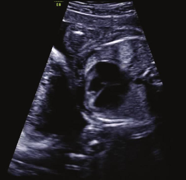 Two weeks later, at 21 + 3 weeks of gestation, the abnormalities progressed with myocardial hypertrophy of the right ventricle and a peak systolic velocity across the pulmonary valve of 1.75 m/s.
