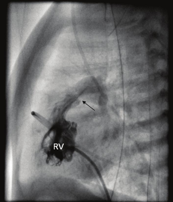 Case Reports in Pediatrics 3 (b) (a) Figure 2: (a) Depicts the stenosis of the pulmonary valve during contrast injection into the right ventricle (RV) obtained during cardiac catheterization.