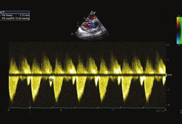 (c) Shows the continuous wave Doppler tracing along the main pulmonary artery with a peak gradient of 12 mmhg.