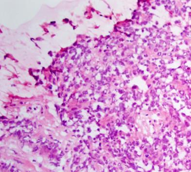Patient diagnosed with metastatic prostate cancer 55 yo patient with T4N1M1 Gleason 10 PCa