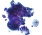 Liquid based cytology The sample of (epithelial) cells is taken from the Transitional Zone; the squamo-columnar junction of the cervix, between the ecto and endocervix.