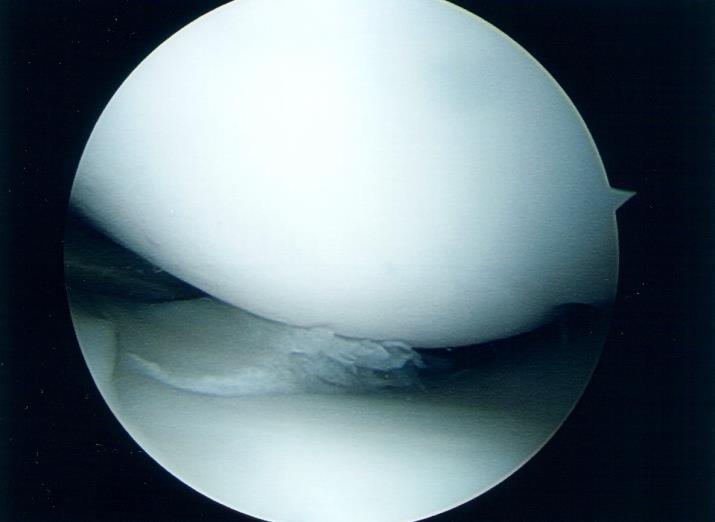 Figure 12: A parrot beak tear. IMAGING Good clinical history taking and examination techniques mean that clinical diagnosis of meniscal pathology can be very accurate.