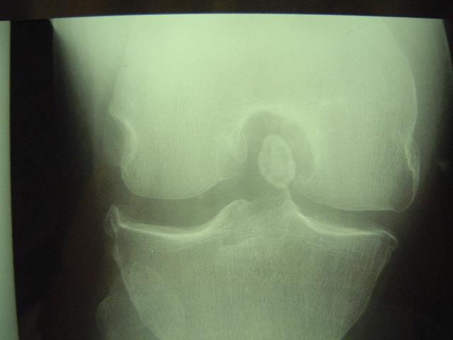 Occasionally conditions such as osteochondritis dessicans may present with a similar history to meniscal tear, and this can be identified on X-ray.