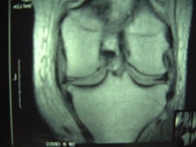 Figure 14: A torn meniscus seen on MRI. TREATMENT Conservative Undoubtedly some meniscal tears heal without surgical intervention.