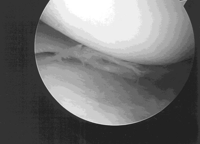 Figure 16: A torn meniscus requiring a partial meniscectomy. The torn tissue plus any other abnormal tissue is removed. The rim is smoothed and trimmed.
