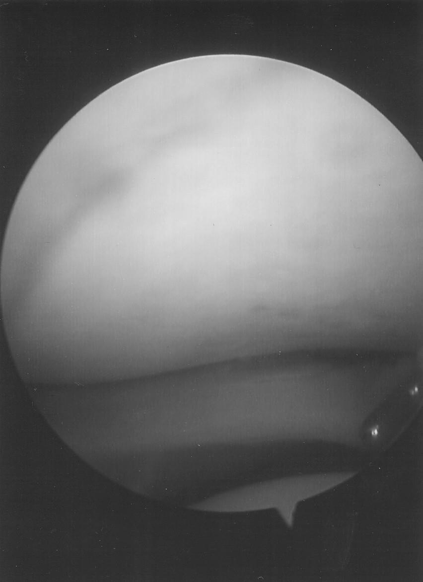 Figure 4: A peripheral tear of the lateral meniscus seen in an ACL deficient knee.