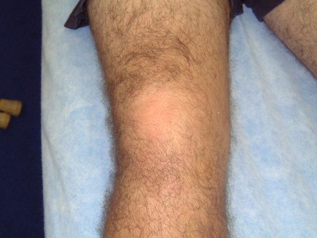 tear, an osteochondral fracture (usually associated with a dislocated patella), a tibial plateau fracture or a tear of the meniscus in the vascular zone. Swelling that occurs later i.e. within 24 hours usually indicates an effusion or a synovial exudate, which in itself is an important indicator of intra-articular pathology.
