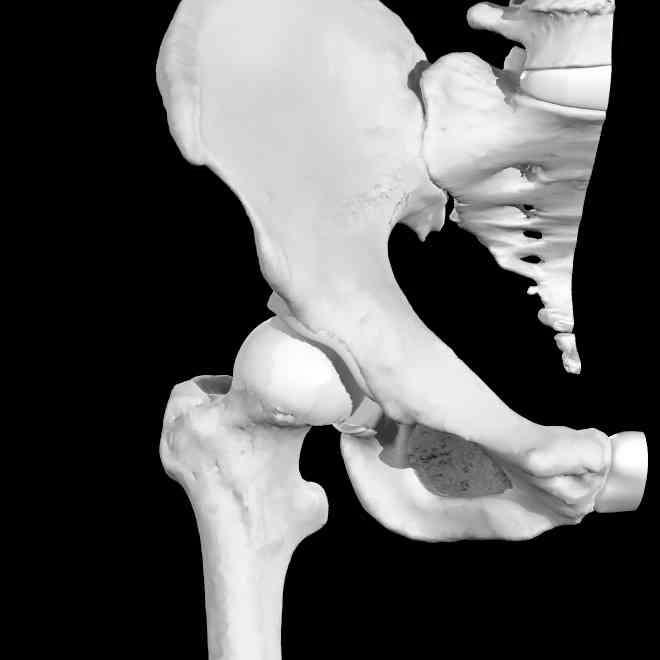 Perhaps the two most common current indications for hip arthroscopy include the presence of symptomatic FAI or an acetabular labral tear, or both.