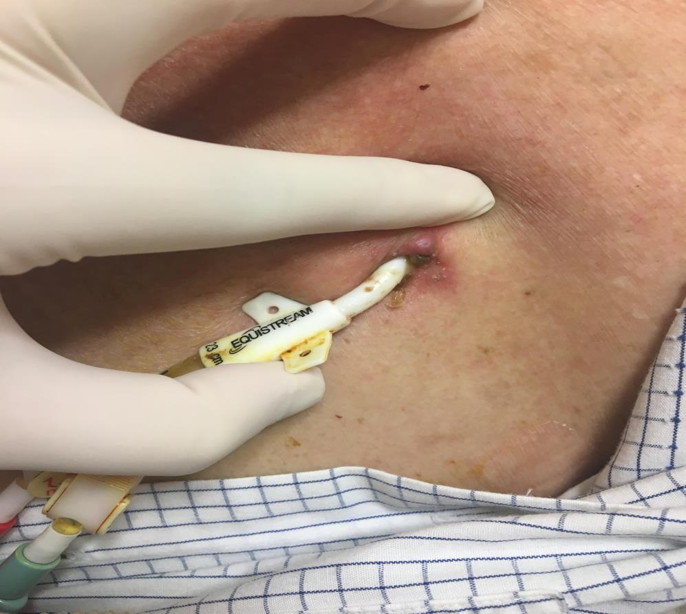 Picture showing redness around the hemodialysis tunneled catheter skin exit site