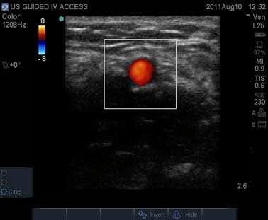 160 Sonography Color Doppler is an application to characterize blood flow. The doppler effect occurs when blood flow of red blood cells move toward or away the ultrasound transducer.