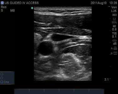 Ultrasound Guided Vascular Access 163 requires that transducer beam, needle and target vessel be held parallel, which can be challenging for the novice user.