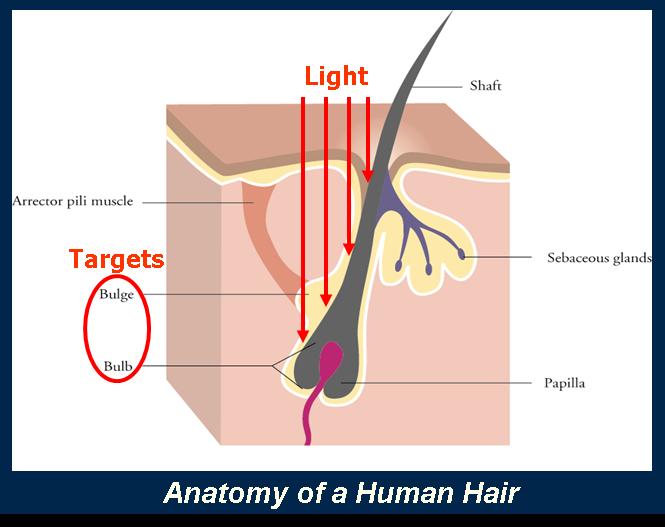 HAIR REMOVAL PROCESS The purpose of the treatment is to selectively treat the hair follicle without causing thermal damage to the surrounding tissue.