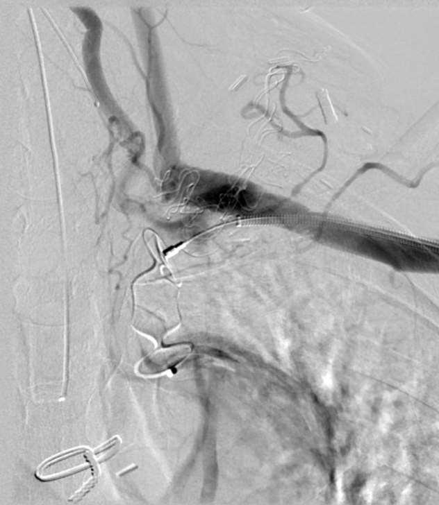 Operation #1 L carotid-subclavian bypass