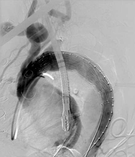 infra-renal aorta for TEVAR IVUS to access dissection true