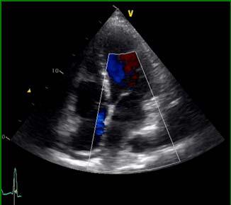 PASP~38mmHg, Moderate to severe MR 13 14 Right heart cath HD#3: LVEDP 18 mmhg PA PCWP CO CI SVR PVR PA Sat 46/29 25 2.4/2.9 1.13/1.