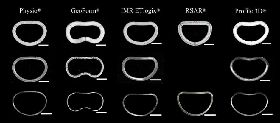 IMR-FMR disease-specific ring designs Disproportionate septal-lateral