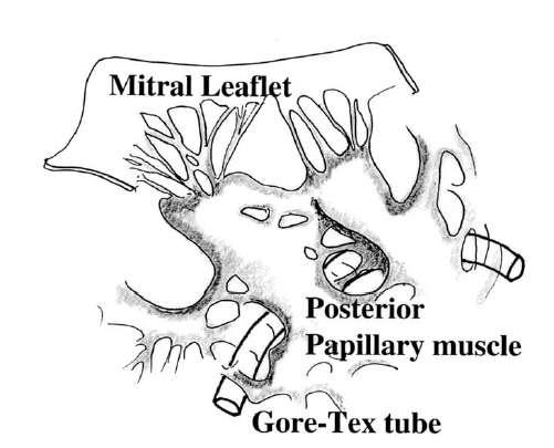 Ventricular Level Approaches Hvass Papillary Muscle