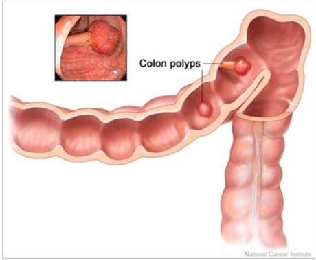 Risk Factor - Polyps Different types of polyps: Hyperplastic Low risk: very small chance they ll grow into cancer