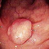 cancer The Adenoma-Carcinoma Sequence Most cancers of the colon and rectum develop from adenomatous polyps Estimates of