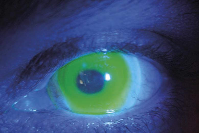 Figure 3 Heavy corneal touch, change with