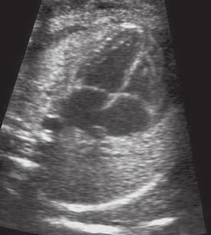 The left atrium and ventricle lie posteriorly, so are hidden from view from the front. The arterial trunks in the upper thorax are covered by the thymus.