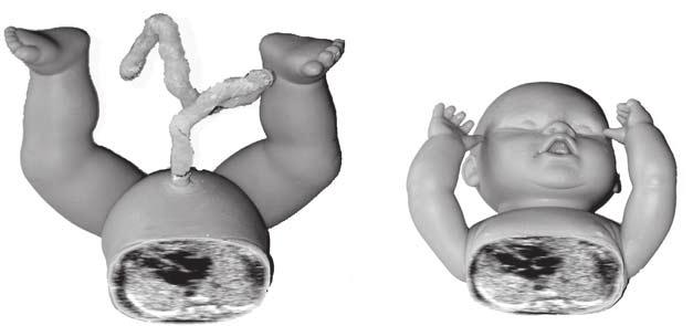 described, including that from Cordes as follows. In the long axis of the fetus, the head is positioned to the right on the screen (whichever side it truly lies).