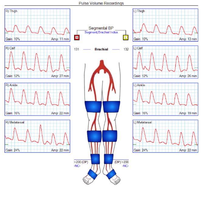 Pulse Volume Recording (PVR) Measures pressure changes in the bladder of the cuff wrapped around