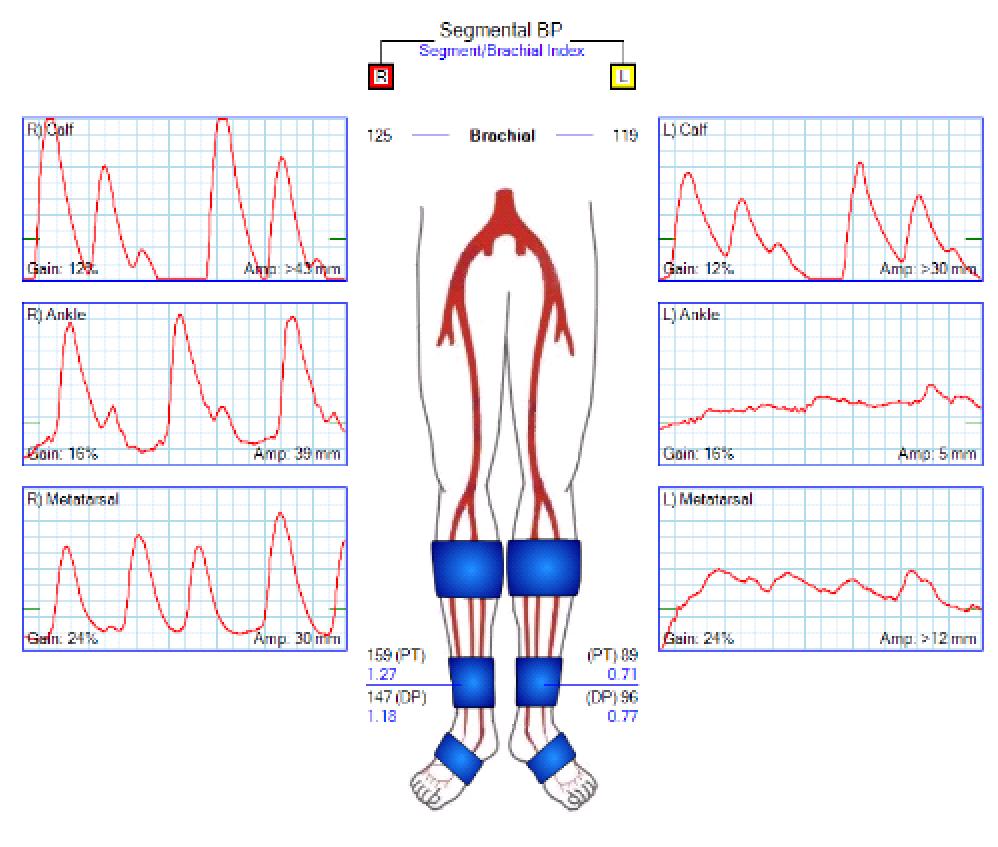 the limb volume Normal PVR has a rapid upstroke with a dicrotic notch Advantage is that it is not