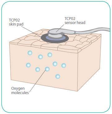 The SPP and TcPO 2 - Examine the microcirculation or skin capillaries within the skin layer Transcutaneous oxygen (TCOM or TcPO 2 ) Measurements Oxygen