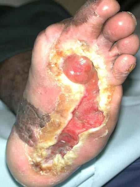 Diabetic foot ulcer Major complication of DM, and probably the major component of the diabetic
