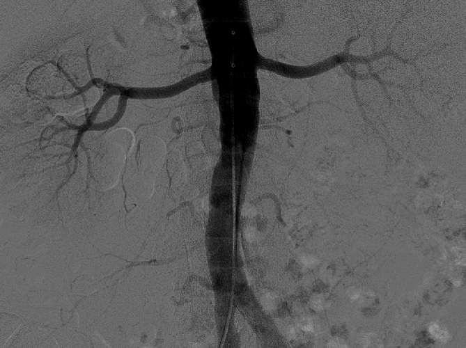 Eligible Anatomy Absence of flow-limiting obstructions and significant disease Diameter 4 mm in