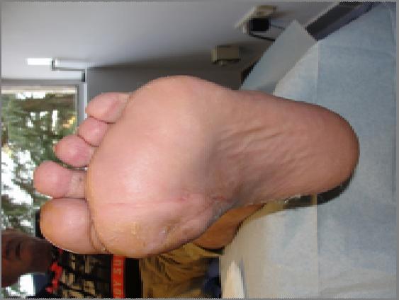 hospitalized for diabetic foot ulcers: a 6.
