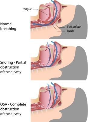 person stops breathing in their sleep, they are partially awakened from sleep as their brain is forced out of deeper stages of sleep to get the body to begin breathing again.