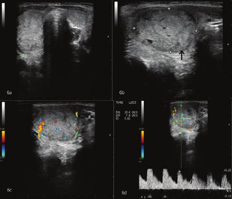CONCLUSION The presence of gray scale ultrasound features of lobulated/ poorly defined margins, predominantly solid composition, hypoechoic echotexture and thick incomplete /absent halo were