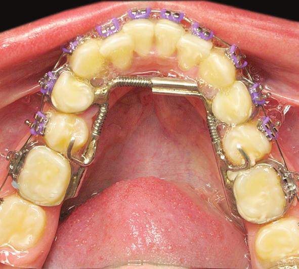 Maxillary Expander Eliminates at home confusion of