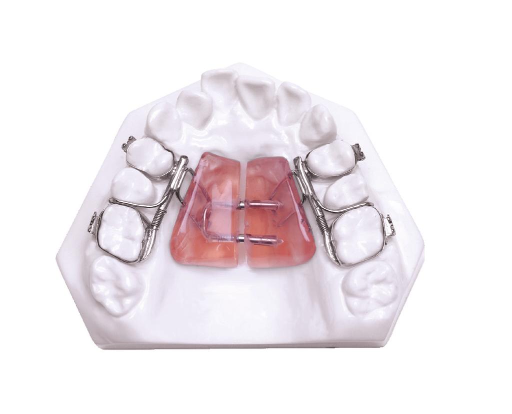 Maxillary Arch Expander Utilizes either a