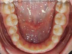 Guiga built up her teeth with flowable resin and lasered her gums in order to