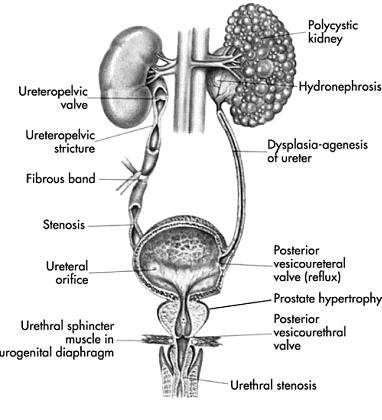 Advanced Pathophysiology Unit 7: Renal-Urologic Page 3 of 6 DIAGNOSIS: OBSTRUCTIVE UROPATHY Benign Prostatic Hypertropy (BPH) and anything else?