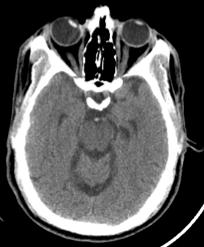 He does not spontaneously move any extremities Labs: Lytes, CBC, BUN/Cr, LFTs, Utox all nl CT Brain in the ED: Negative Patient admitted to the medicine