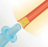 Choosing Your Intermittent Catheter Size and Design Catheters come in a variety of sizes, materials, and styles. Catheters are sized on the French scale, (abbreviated Fr.