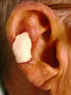 Wound care After tumor excision, the wound: is filled with sized collagen sponges or powder Cover with Aquaphor and then Telfa or Adaptic Bolster down the graft for 5-7 days Apply gauze and then