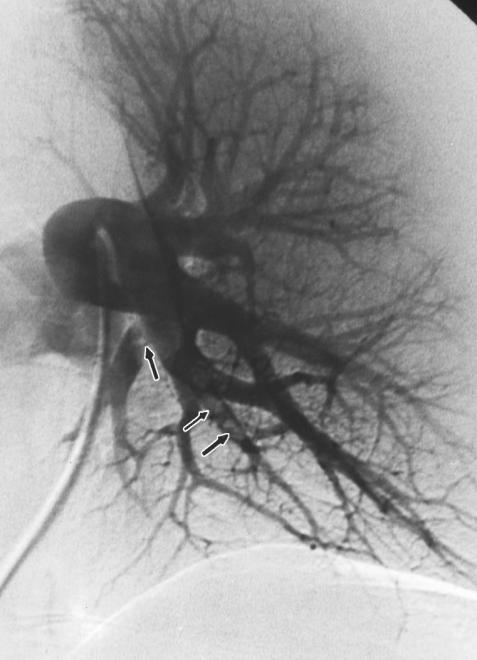Pulmonary Angiography in PE Was the