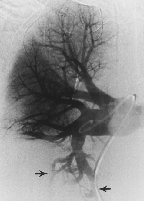 angiogram excludes clinically