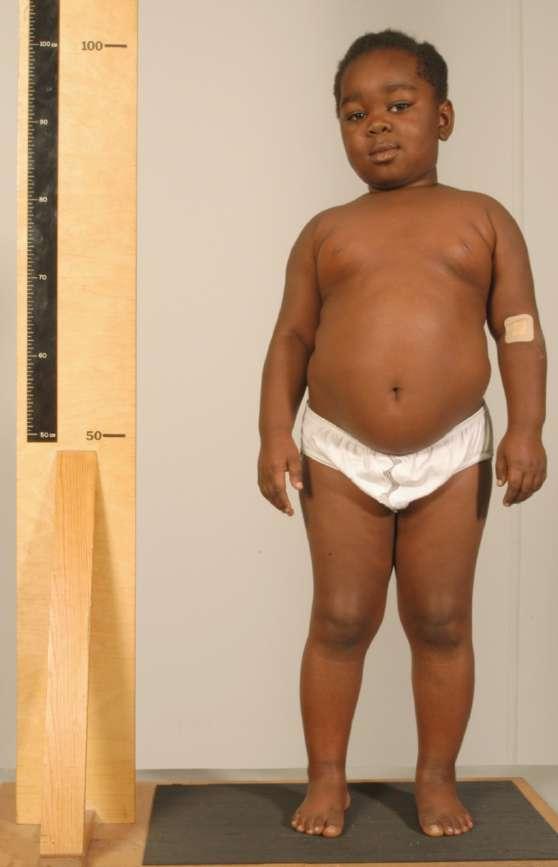 Case 2 Marked short stature Cause not defined Differential diagnosis: Skeletal dysplasia Storage Disorder