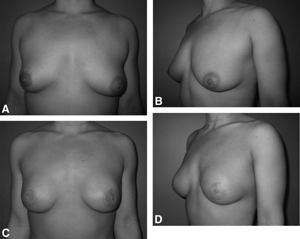 Annals of lastic Surgery Volume 65, Number 1, July 2010 Bilateral Breast Reconstruction impairment in daily activities, however, 10/37 did report some impairment in physical activities, most of these
