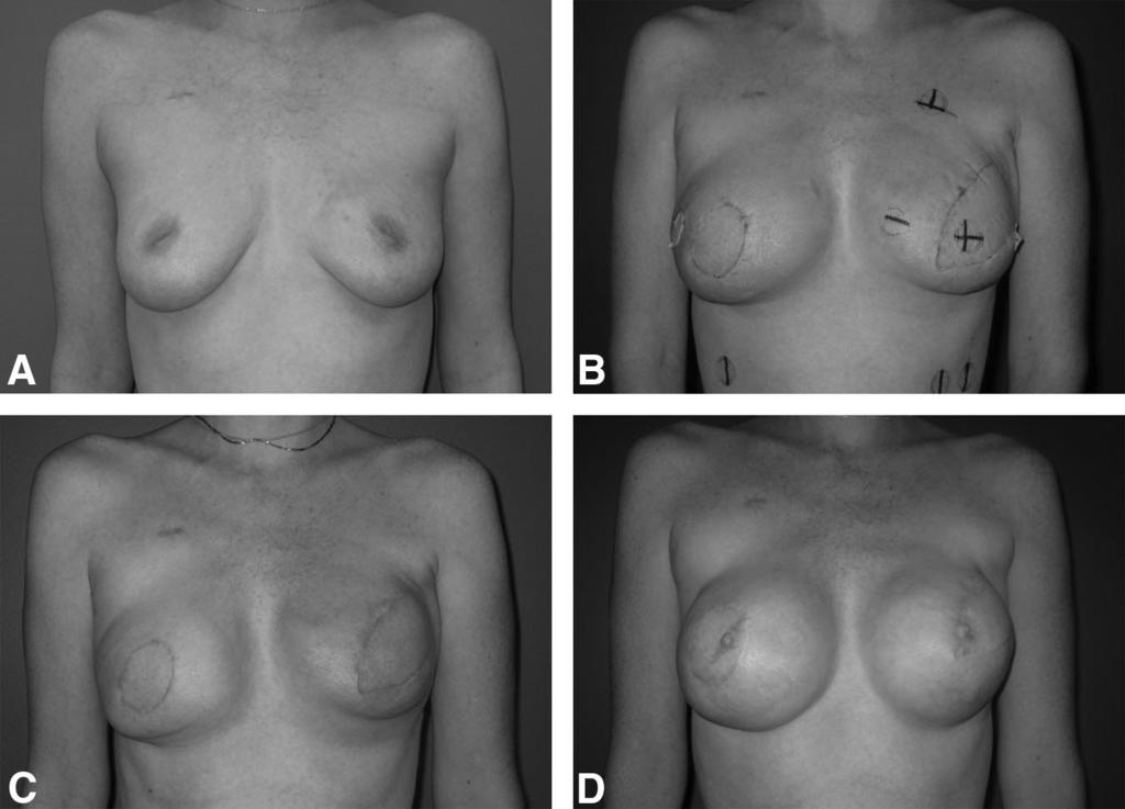 She opted for a bilateral mastectomy and had a bilateral latissimus dorsi reconstruction with expanders.