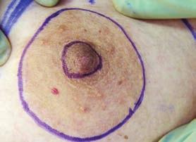 OTHR ONSIRTIONS Simultaneous reola Reconstruction To perform a true one-stage breast